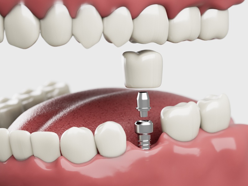 Dental implant
