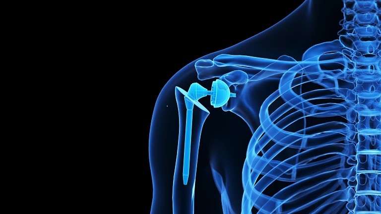 Shoulder Implant