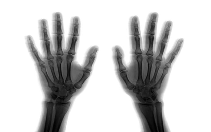Hand arm vibration X-Ray image