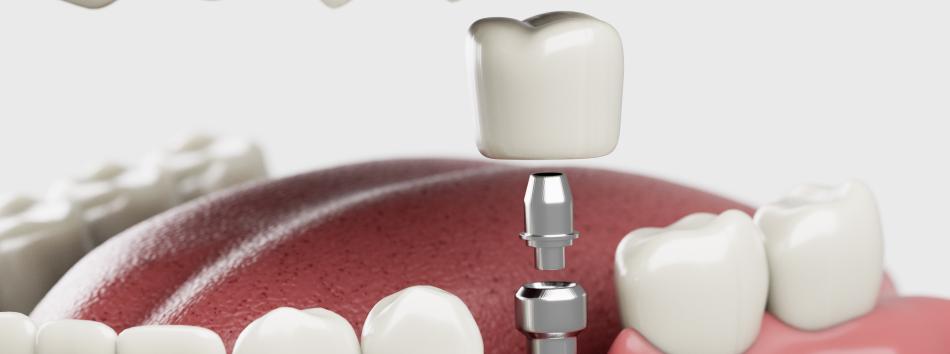 Dental implant