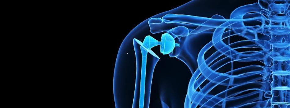 Shoulder Implant