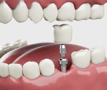 Dental implant
