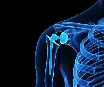 Shoulder Implant