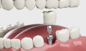 Dental implant