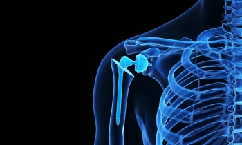 Shoulder Implant