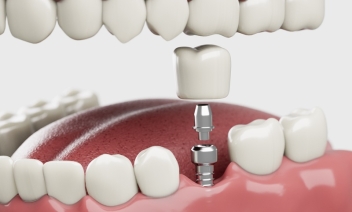 Dental implant