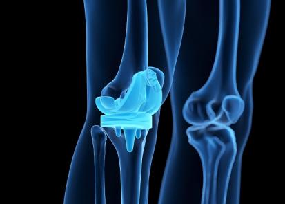 Medical knee implant
