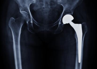 Hip implant